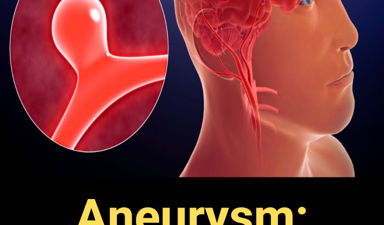 Aneurysm: Signs and Symptoms You Shouldn’t Ignore